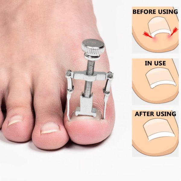 Toenail Correction Tool